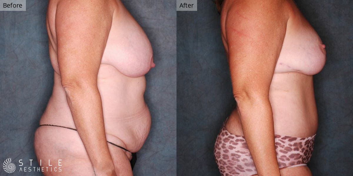 Mommy Makeover Before & After Gallery - Patient 334683 - Image 2