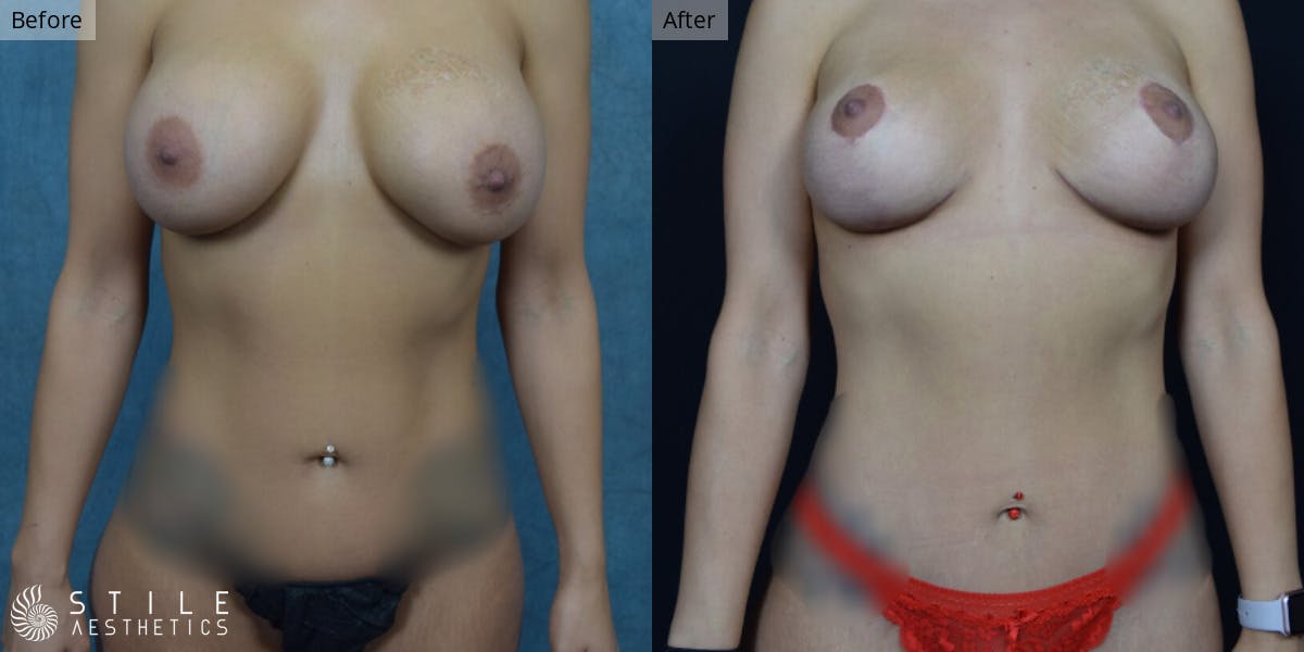 Mommy Makeover Before & After Gallery - Patient 366430 - Image 1