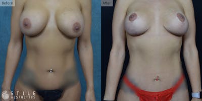 Mommy Makeover Before & After Gallery - Patient 366430 - Image 1