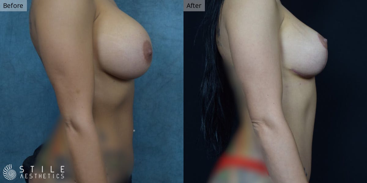 Mommy Makeover Before & After Gallery - Patient 366430 - Image 2
