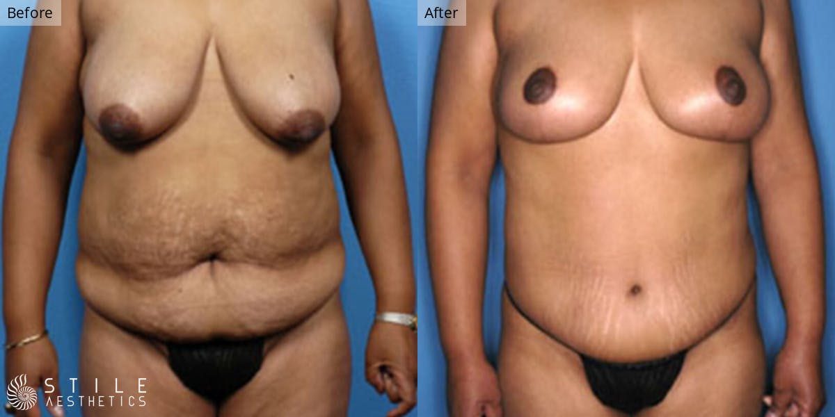 Mommy Makeover Before & After Gallery - Patient 279803 - Image 1
