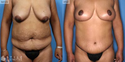 Mommy Makeover Before & After Gallery - Patient 279803 - Image 1
