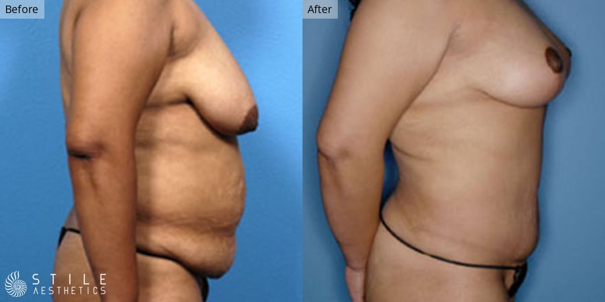 Mommy Makeover Before & After Gallery - Patient 279803 - Image 2