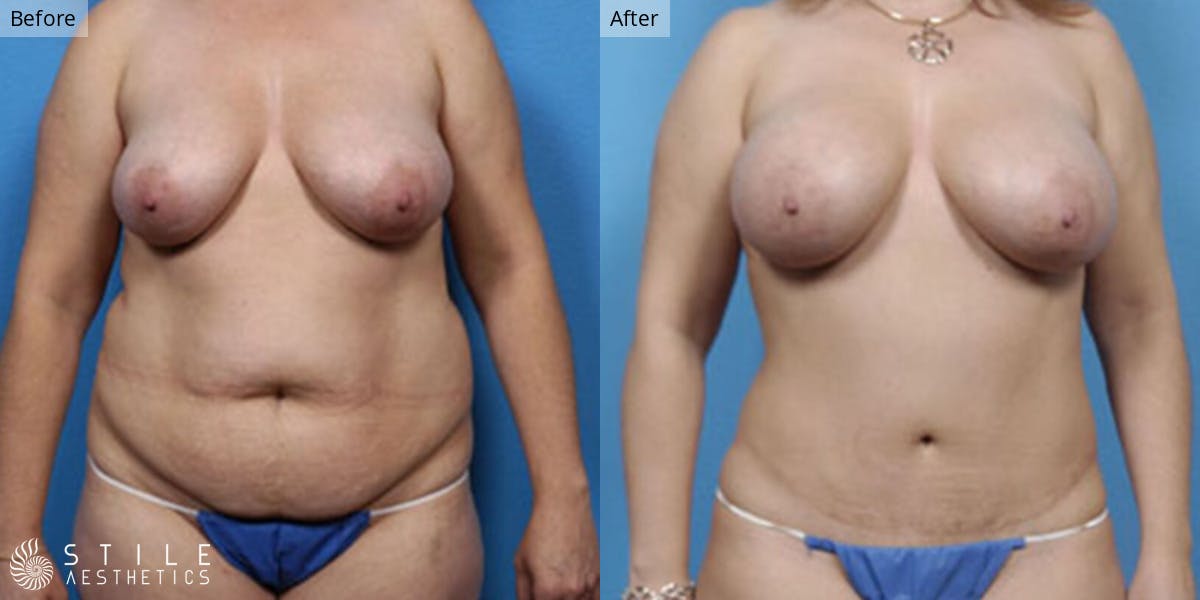 Mommy Makeover Before & After Gallery - Patient 114190 - Image 1