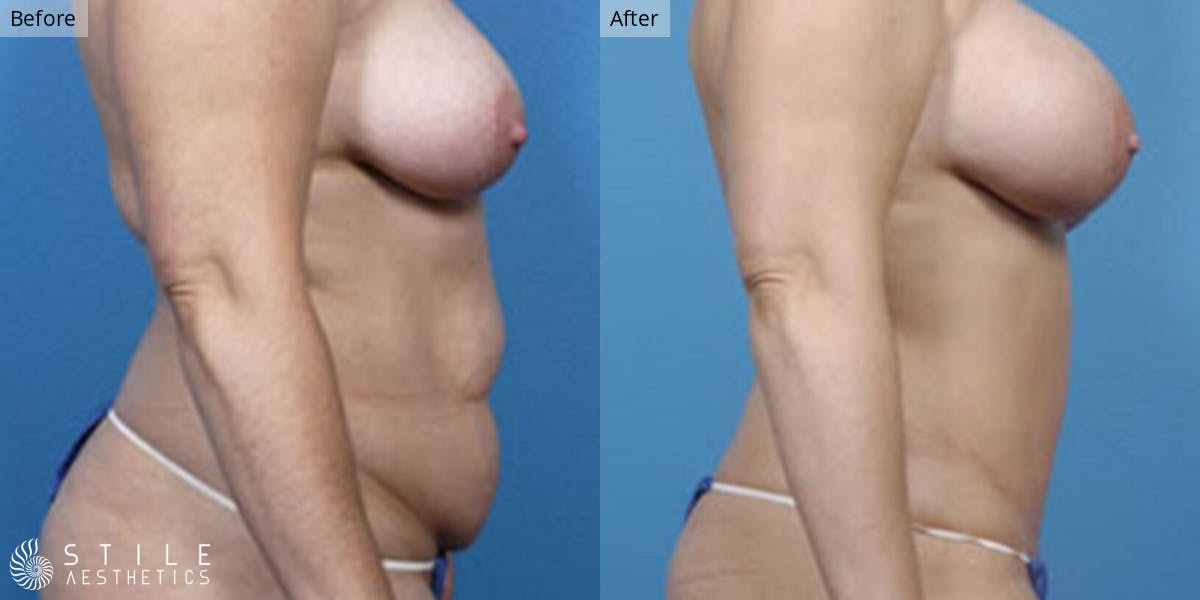 Mommy Makeover Before & After Gallery - Patient 114190 - Image 2