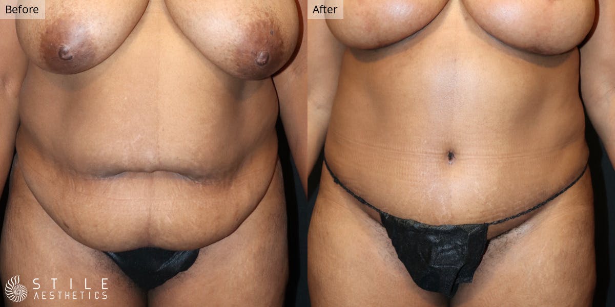 Mommy Makeover Before & After Gallery - Patient 106566 - Image 1