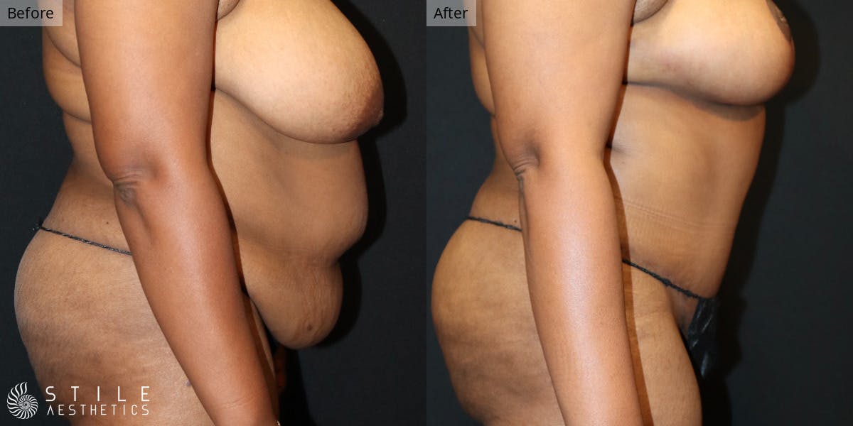 Mommy Makeover Before & After Gallery - Patient 106566 - Image 2