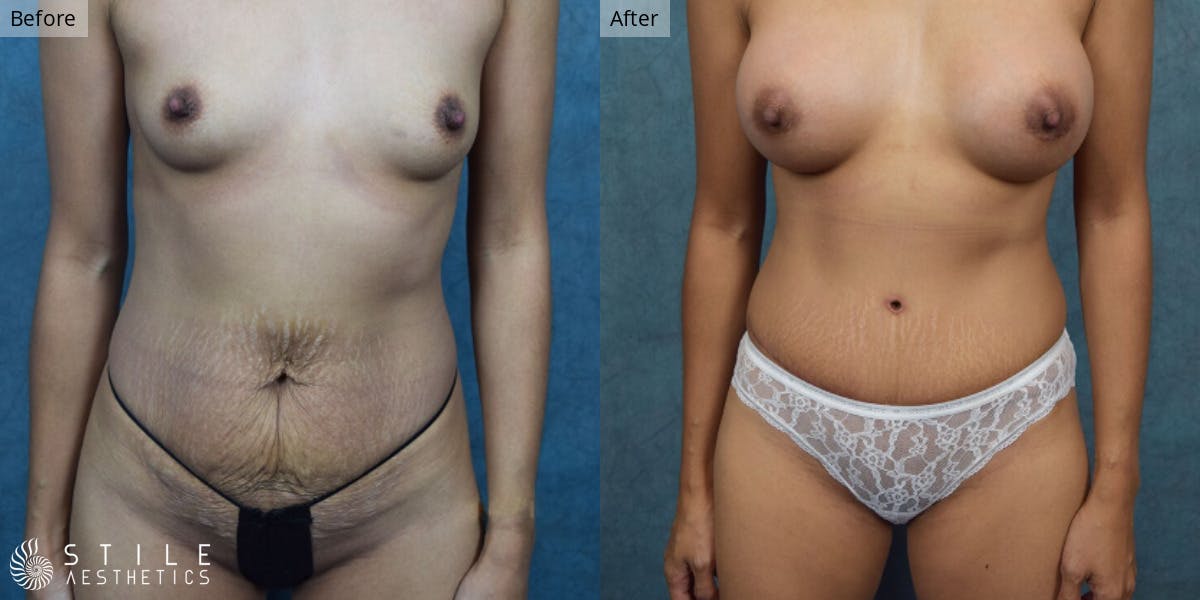 Mommy Makeover Before & After Gallery - Patient 397446 - Image 1