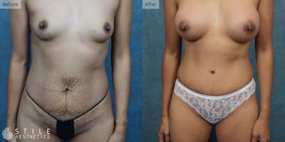 Mommy Makeover Before & After Gallery - Patient 397446 - Image 1
