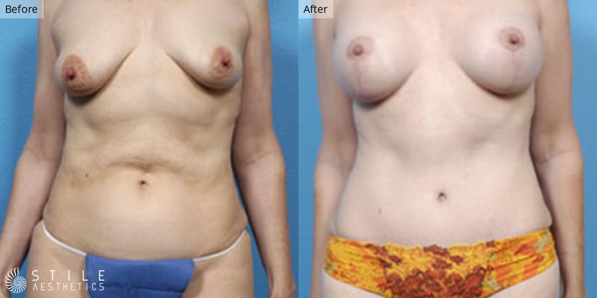 Mommy Makeover Before & After Gallery - Patient 307001 - Image 1