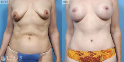 Mommy Makeover Before & After Gallery - Patient 307001 - Image 1