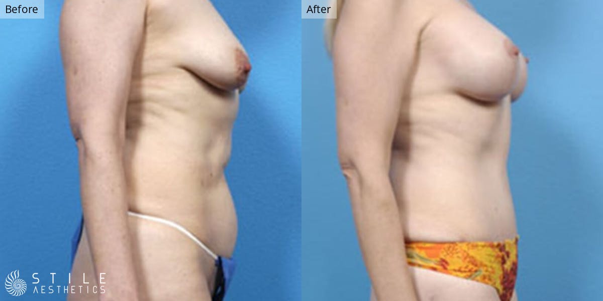 Mommy Makeover Before & After Gallery - Patient 307001 - Image 2