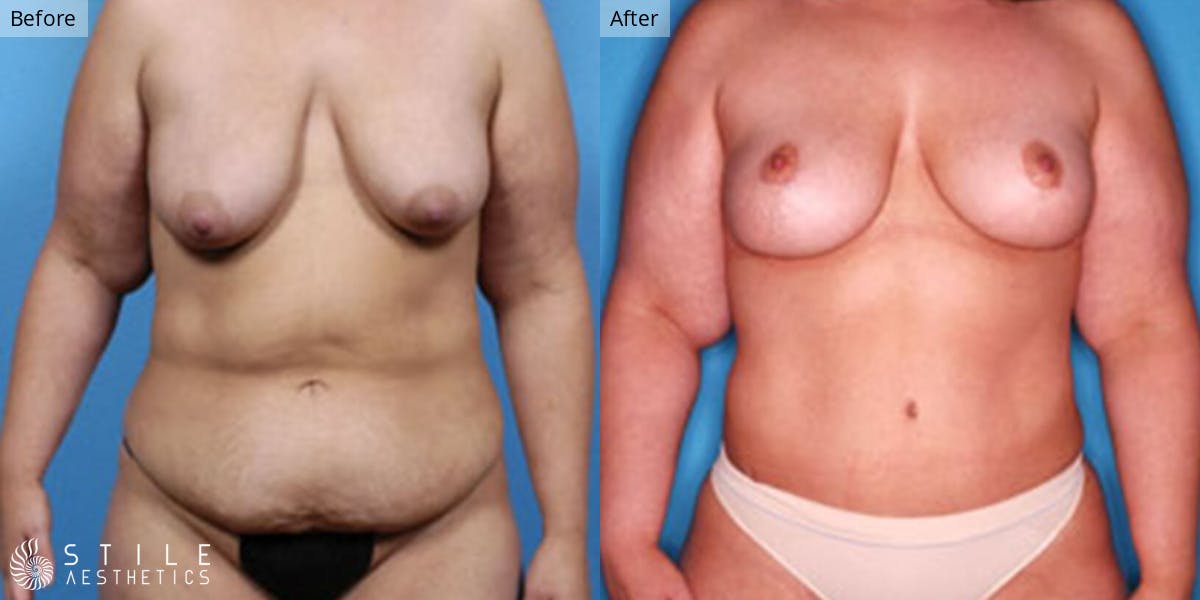 Mommy Makeover Before & After Gallery - Patient 247687 - Image 1