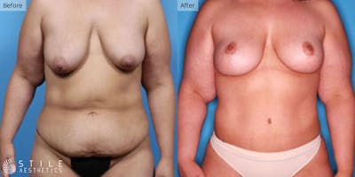 Mommy Makeover Before & After Gallery - Patient 247687 - Image 1