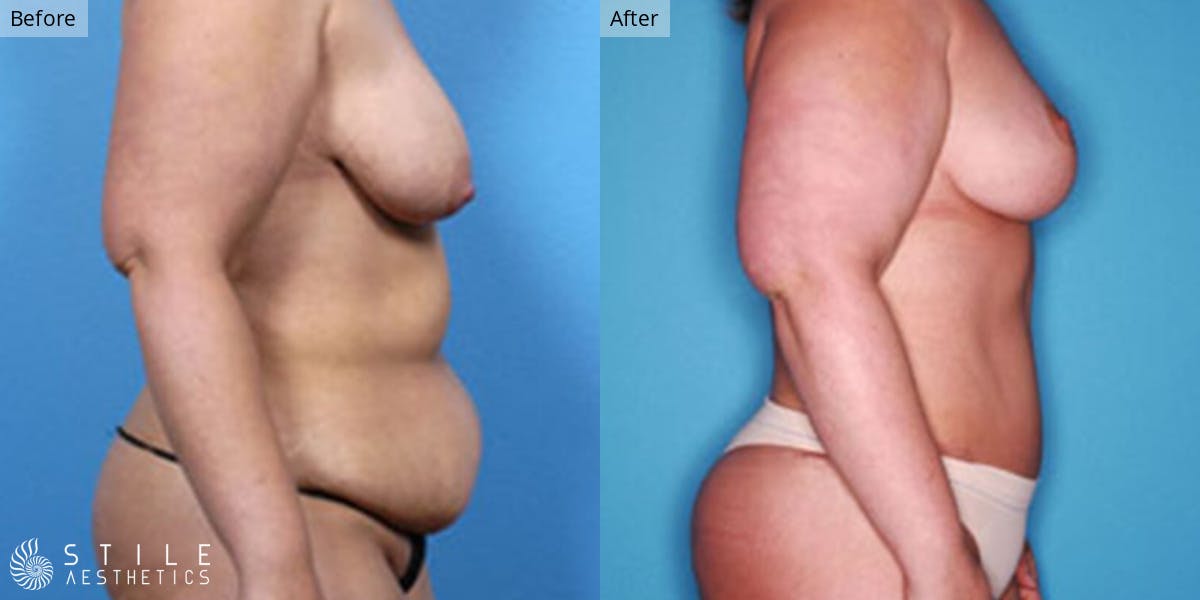 Mommy Makeover Before & After Gallery - Patient 247687 - Image 2