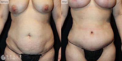 Mommy Makeover Before & After Gallery - Patient 158437 - Image 1