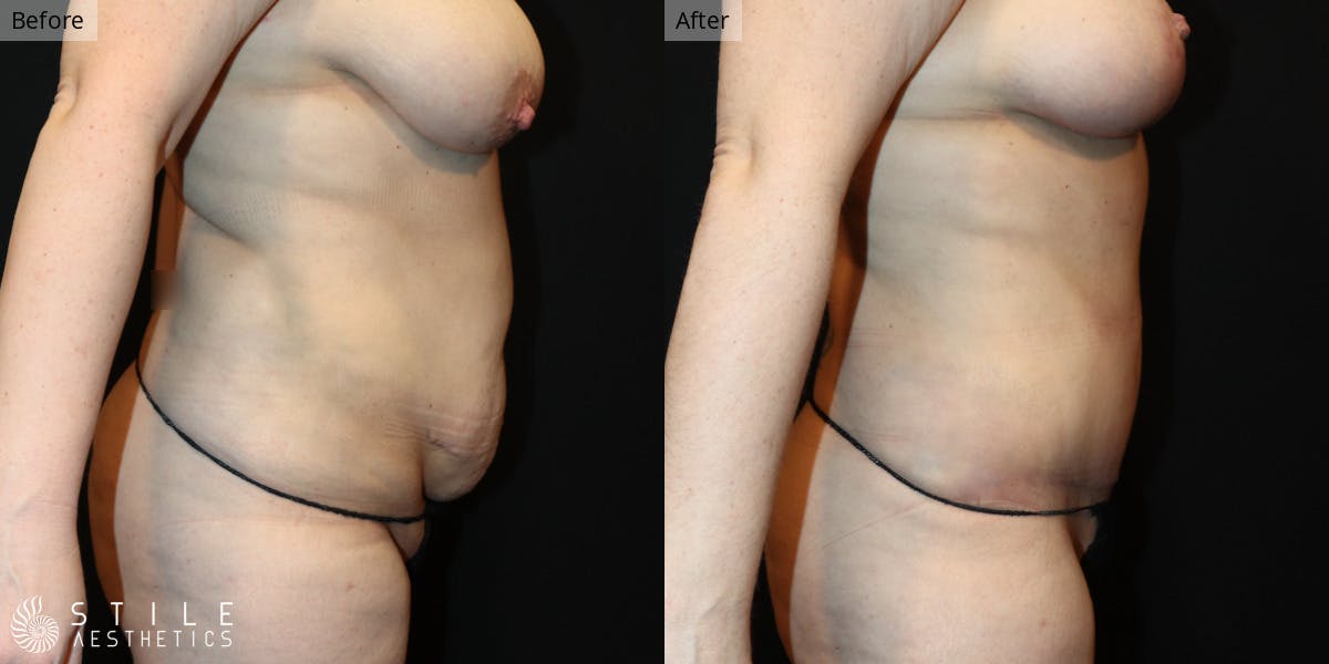 Mommy Makeover Before & After Gallery - Patient 158437 - Image 2