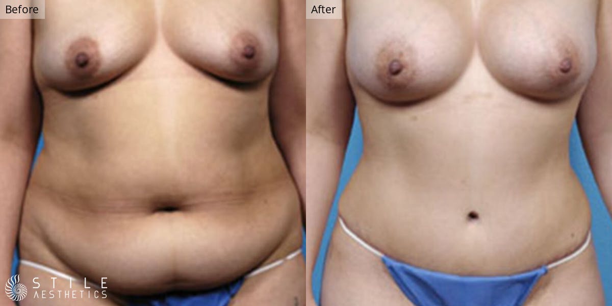 Mommy Makeover Before & After Gallery - Patient 408852 - Image 1