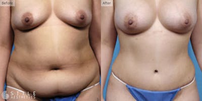 Mommy Makeover Before & After Gallery - Patient 408852 - Image 1