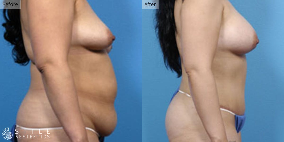 Mommy Makeover Before & After Gallery - Patient 408852 - Image 2