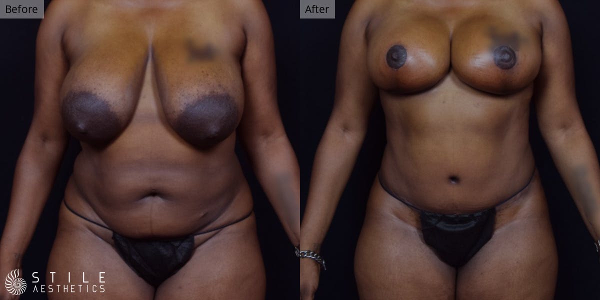 Mommy Makeover Before & After Gallery - Patient 315309 - Image 1