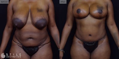 Mommy Makeover Before & After Gallery - Patient 315309 - Image 1