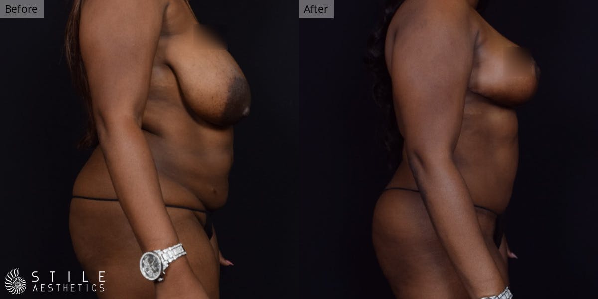 Mommy Makeover Before & After Gallery - Patient 315309 - Image 2