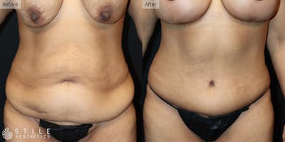 Mommy Makeover Before & After Gallery - Patient 419970 - Image 1