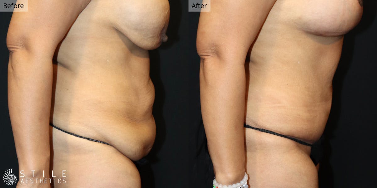 Mommy Makeover Before & After Gallery - Patient 419970 - Image 2
