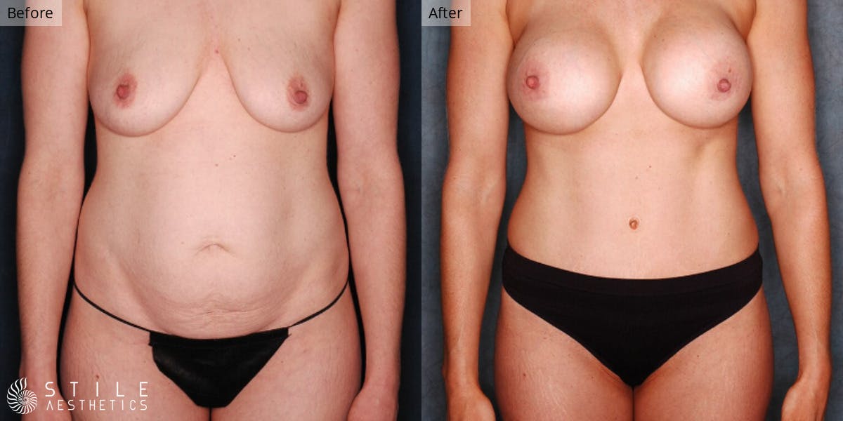 Mommy Makeover Before & After Gallery - Patient 218303 - Image 1