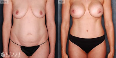 Mommy Makeover Before & After Gallery - Patient 218303 - Image 1
