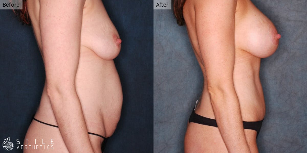 Mommy Makeover Before & After Gallery - Patient 218303 - Image 2