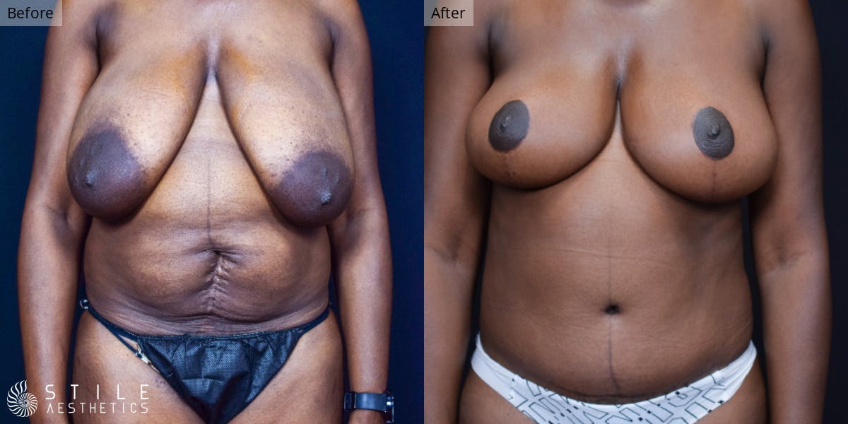 Mommy Makeover Before & After Gallery - Patient 163757 - Image 1