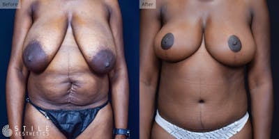 Mommy Makeover Before & After Gallery - Patient 163757 - Image 1