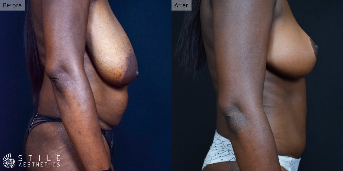 Mommy Makeover Before & After Gallery - Patient 163757 - Image 2