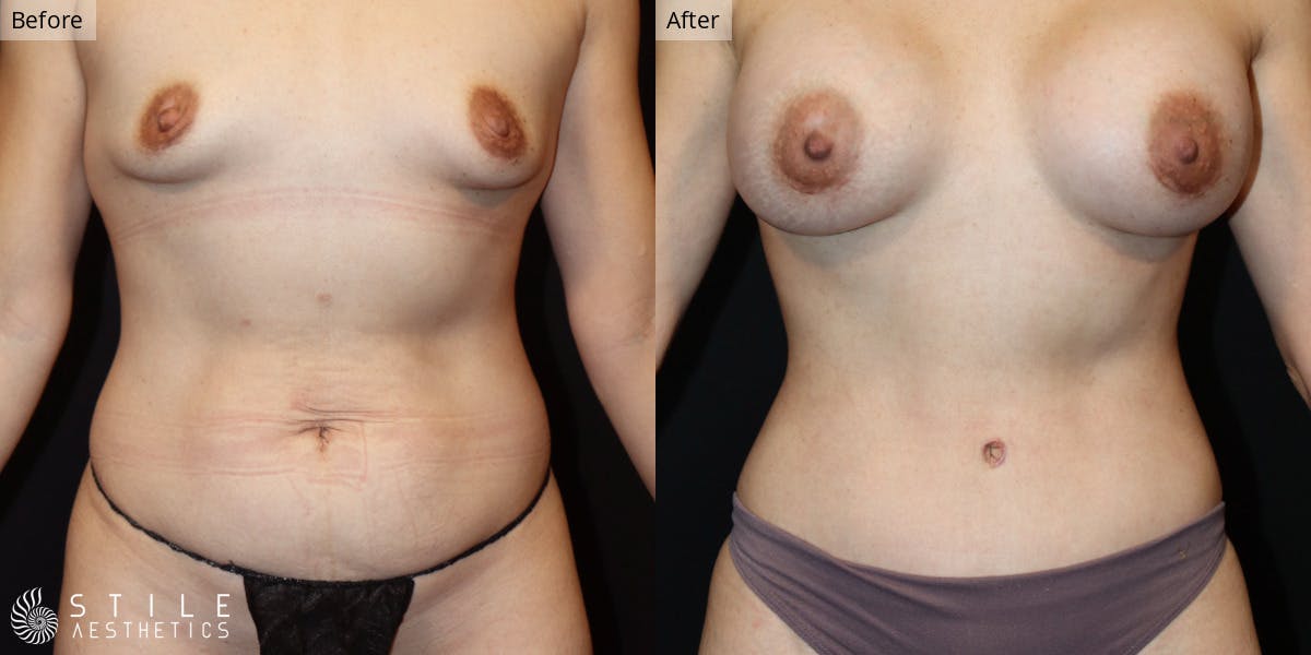 Mommy Makeover Before & After Gallery - Patient 251510 - Image 1