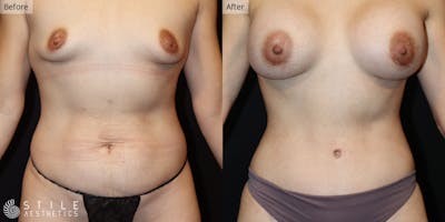 Mommy Makeover Before & After Gallery - Patient 251510 - Image 1