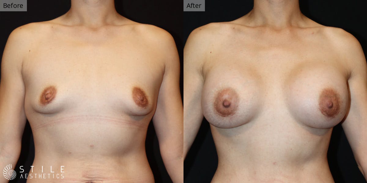 Mommy Makeover Before & After Gallery - Patient 251510 - Image 2