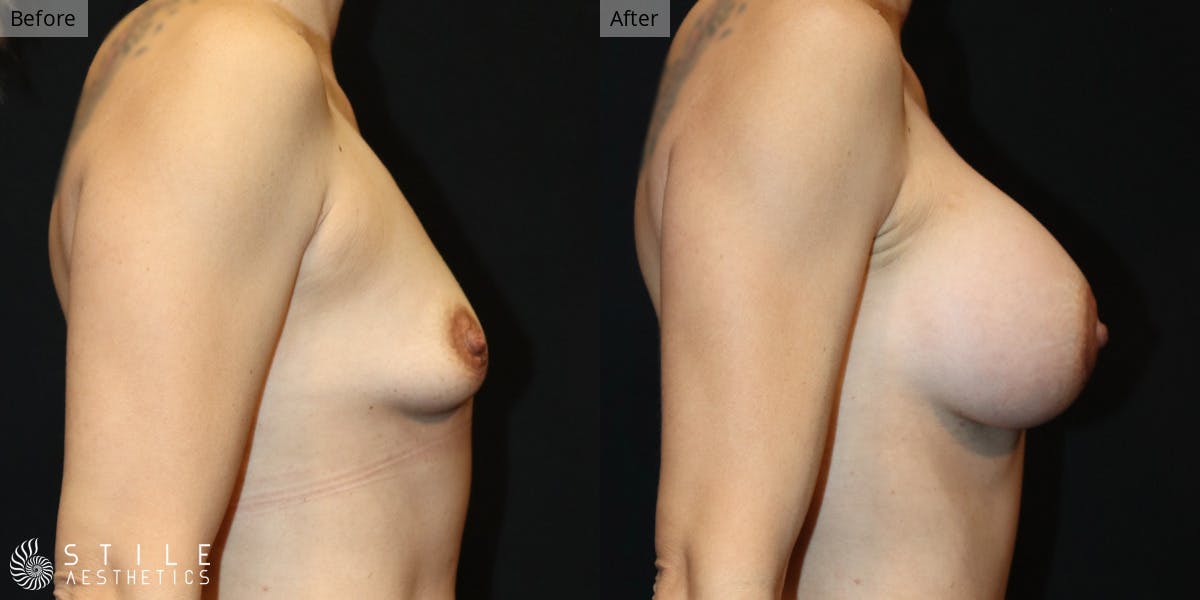 Mommy Makeover Before & After Gallery - Patient 251510 - Image 3