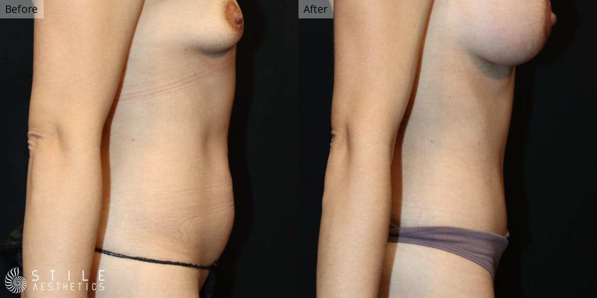 Mommy Makeover Before & After Gallery - Patient 251510 - Image 4