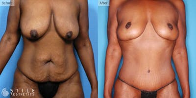 Mommy Makeover Before & After Gallery - Patient 201028 - Image 1