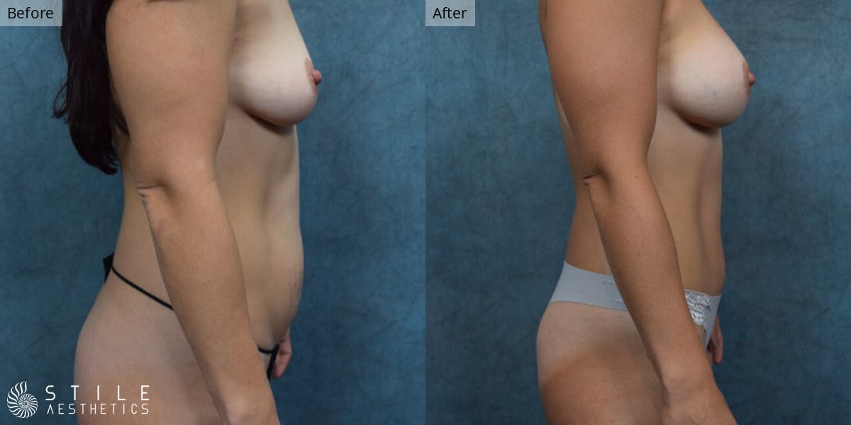 Mommy Makeover Before & After Gallery - Patient 756581 - Image 2