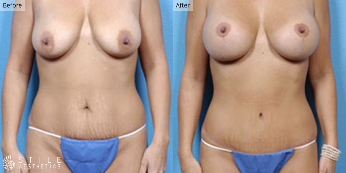 Mommy Makeover Before & After Gallery - Patient 153649 - Image 1