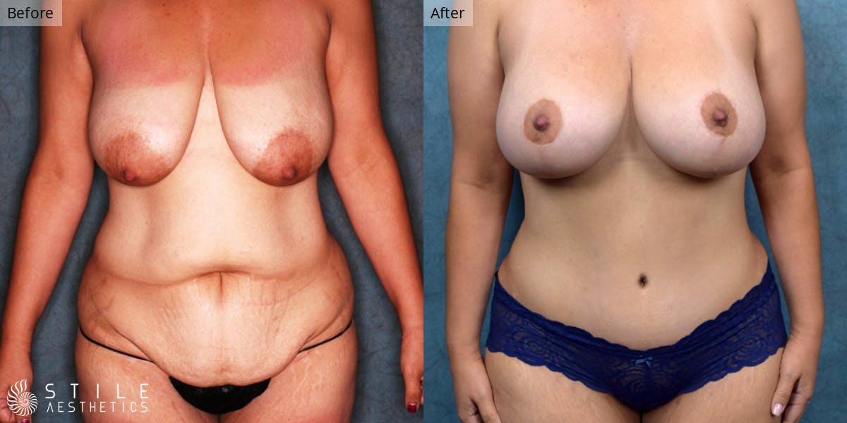 Mommy Makeover Before & After Gallery - Patient 123388 - Image 1
