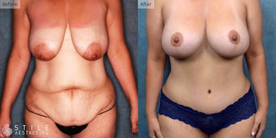 Mommy Makeover Before & After Gallery - Patient 123388 - Image 1