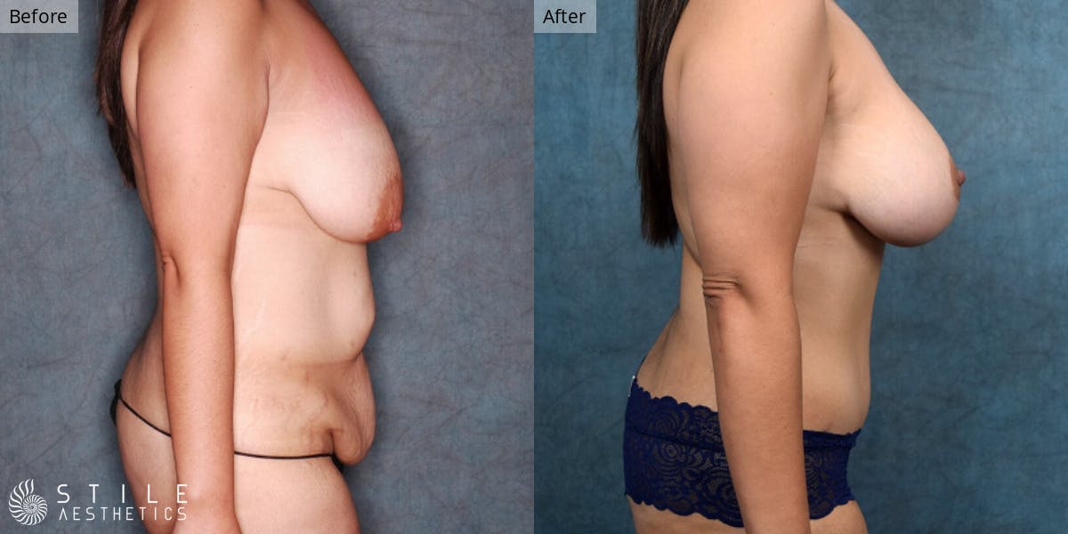 Mommy Makeover Before & After Gallery - Patient 123388 - Image 2