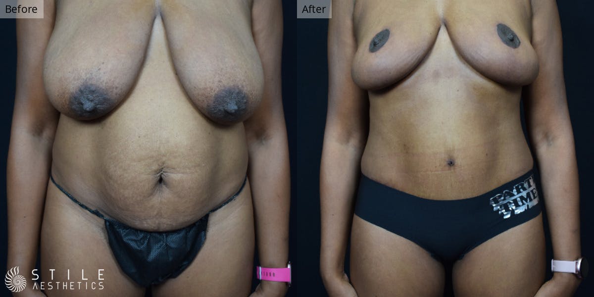 Mommy Makeover Before & After Gallery - Patient 282790 - Image 1