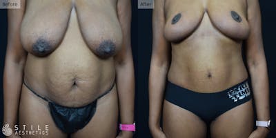 Mommy Makeover Before & After Gallery - Patient 282790 - Image 1