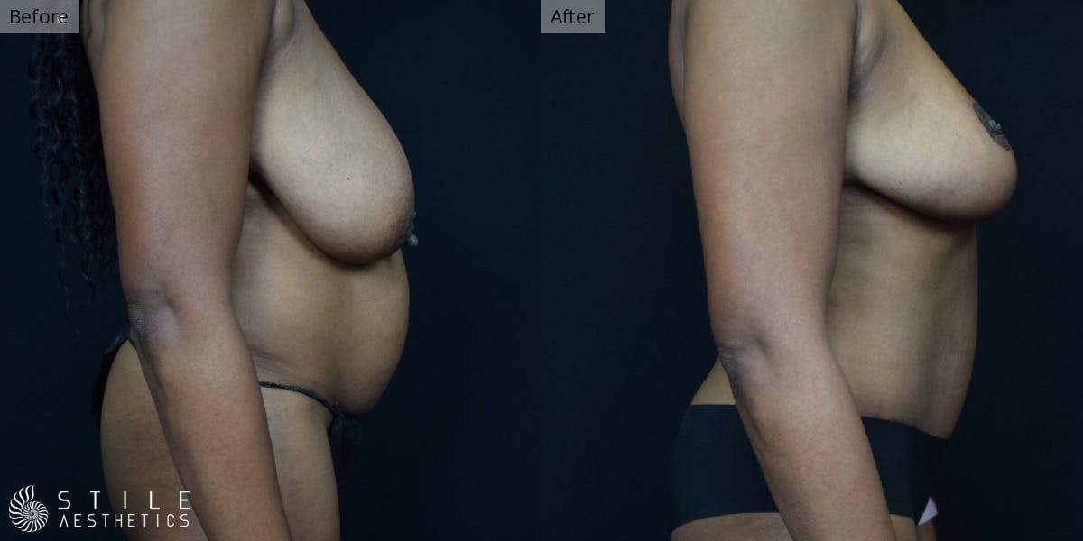 Mommy Makeover Before & After Gallery - Patient 282790 - Image 2