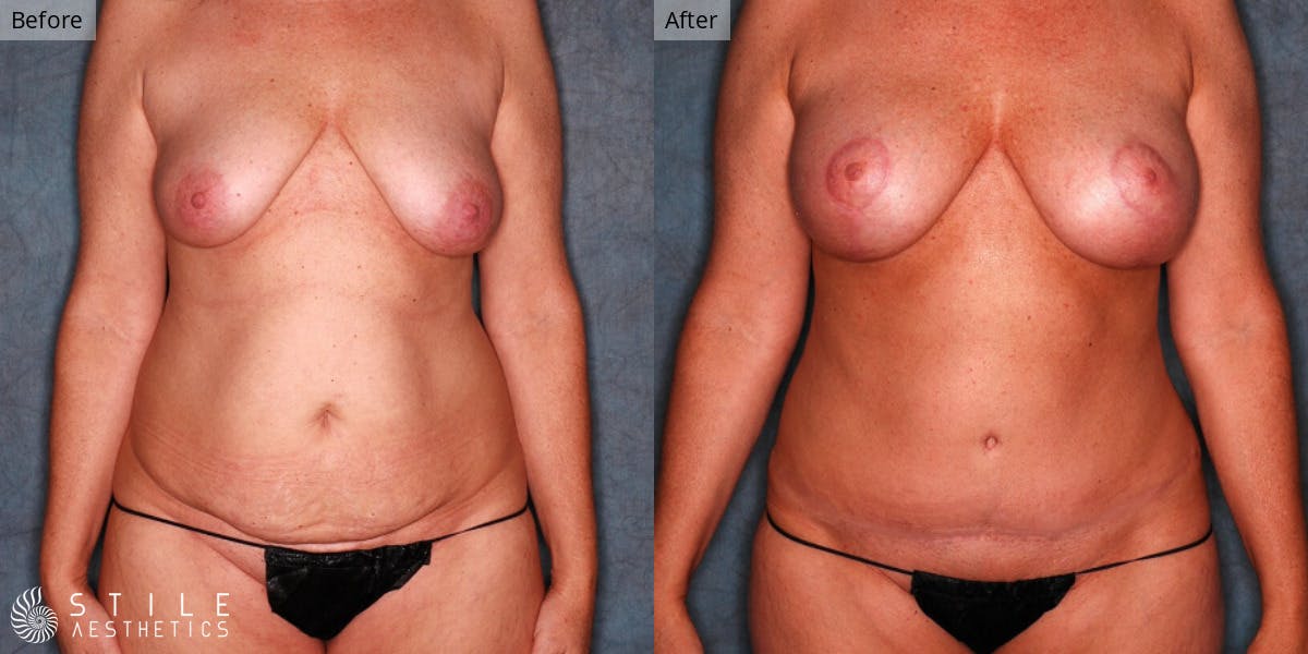 Mommy Makeover Before & After Gallery - Patient 428414 - Image 1